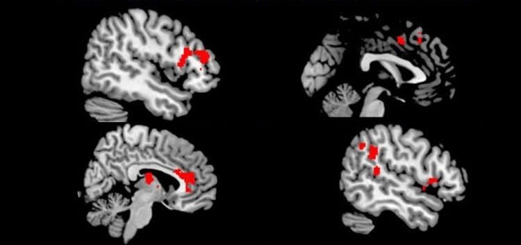 OKB'de fMRI - orbital frontal ve anterior singülat hiperaktivitesi