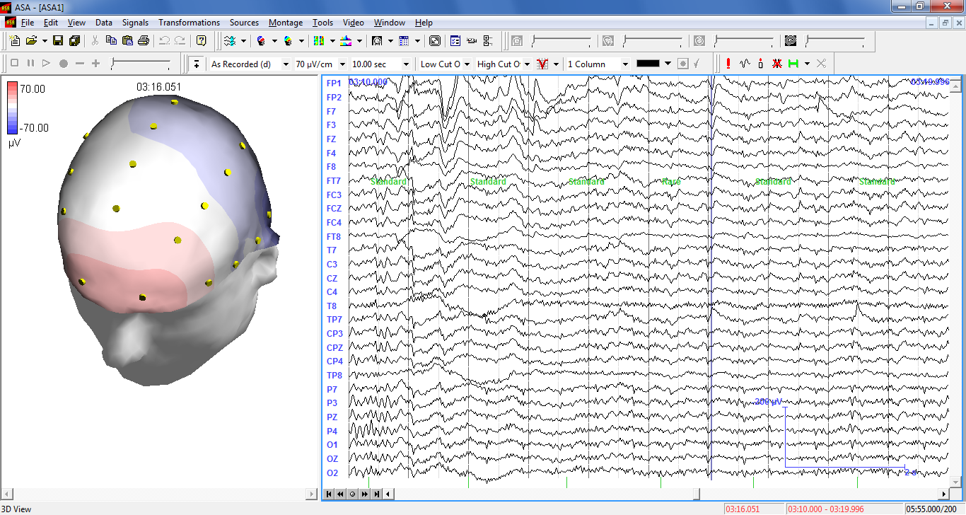 ANT Neuro ASA - qEEG analizi